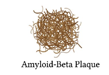 An amyloid-beta plaque. Illustration by MJ Soares